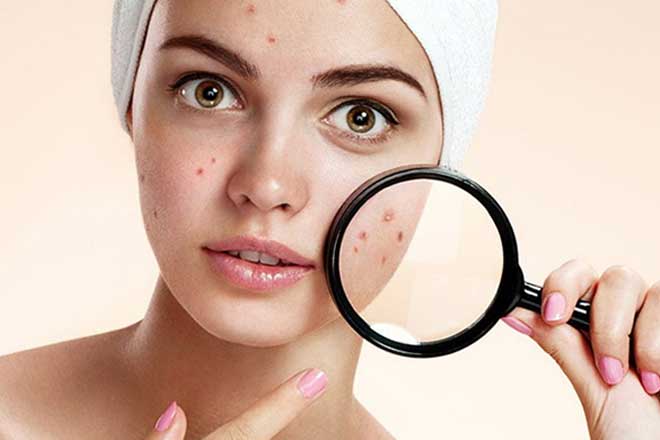 Meilleurs remèdes contre l'acné